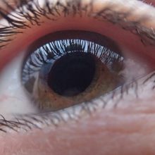 Glokom Nasıl Bir Göz Hastalığıdır?